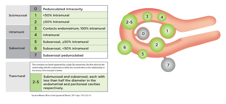 Миоматозные узлы классификация. Классификация миомы по Фиго. Миома матки Figo. Классификация миом матки по УЗИ. Классификация Фиго миома матки.